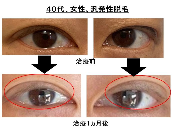 円形脱毛症　病院